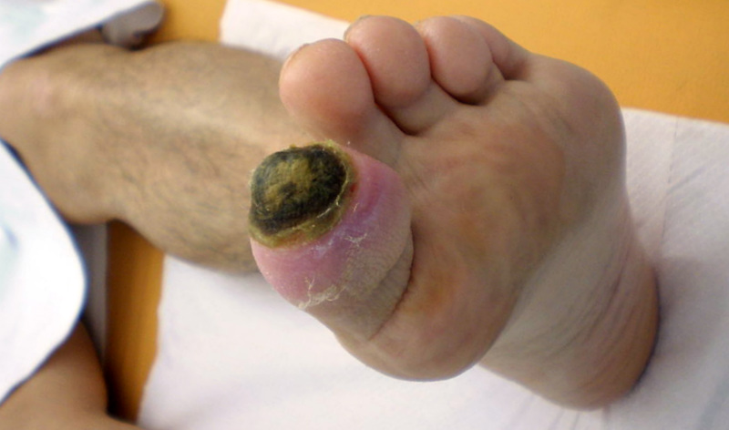 Worse outcomes for diabetic foot ulcers