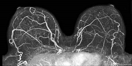 Preoperative breast MRI associated with more testing and mastectomies