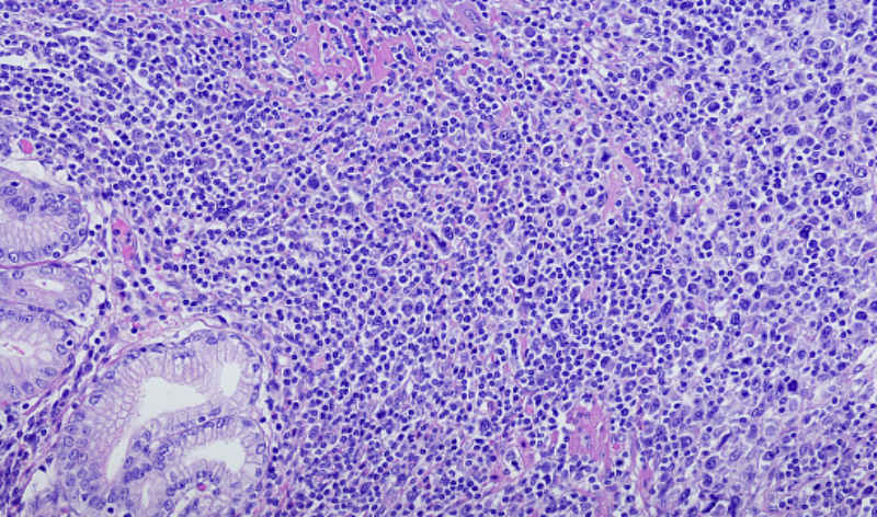 DNA mutations in diffuse large B-cell lymphoma