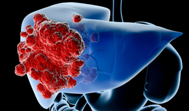 Treat HCV to reduce risk of liver cancer