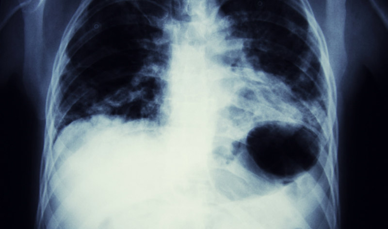 x-ray of lung cancer