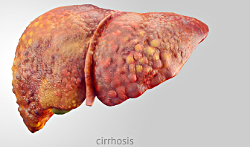 Cirrhosis, hep C treatment, and liver cancer