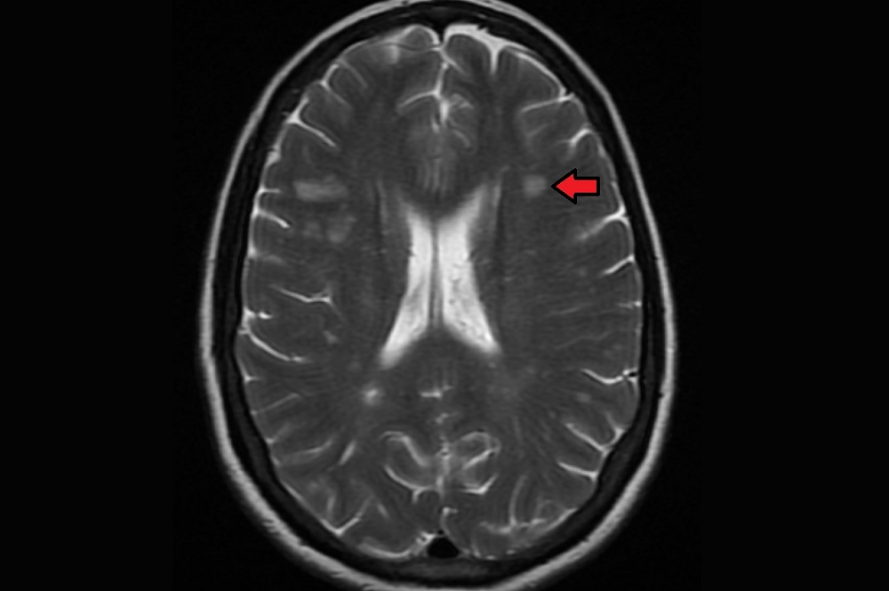 Ocrevus reduced lesions on MRI
