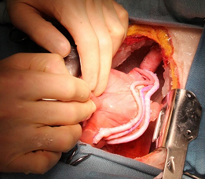 Real Heart Surgery Is Better And Safer After Simulation - 