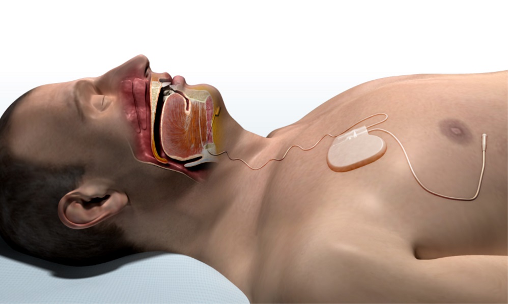 Surgical implant improves apnea, oxygen levels and sleepiness