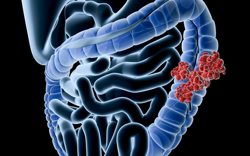Intestinal microorganisms, diet, and colorectal cancer