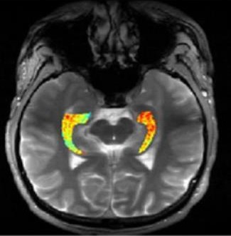 GluCEST imaging reveals epileptic seizure sites