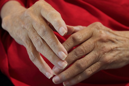 Benefits of baricitinib for rheumatoid arthritis
