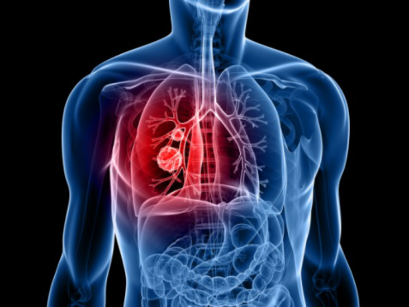 Unresectable stage III NSCLC
