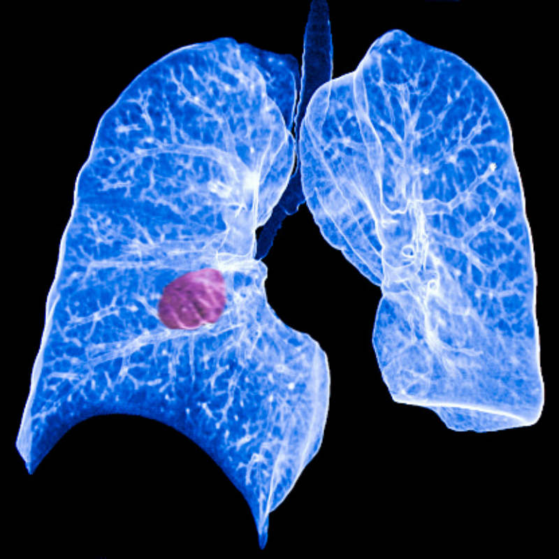Better treatment for NSCLC