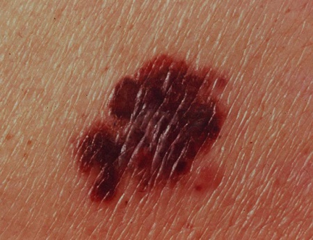 New blood test outperforms current metastatic melanoma testing
