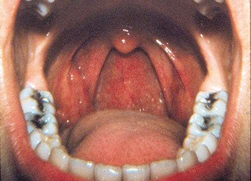 Oral Throat 110