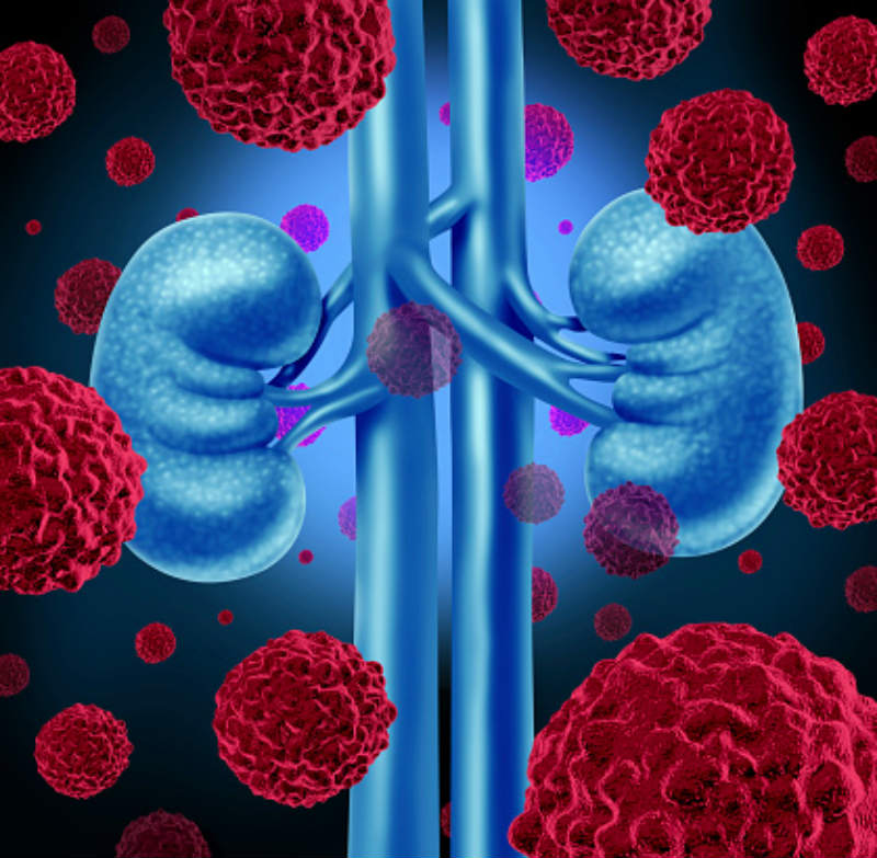 Ruling out kidney cancer