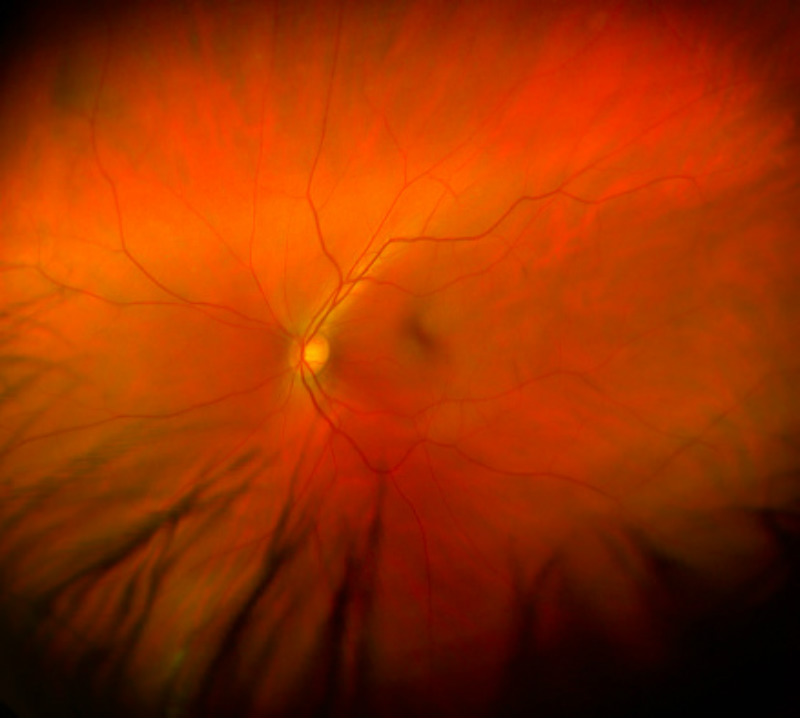 Detection of retinal ß-amyloid deposits in Alzheimer’s disease