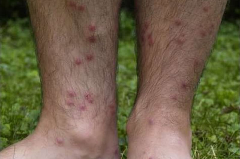 swimmers itch vs chiggers