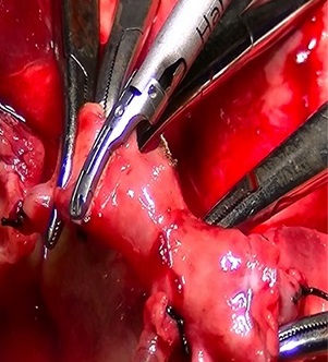 Harmonic Ace +7 Shears used in video-assisted thoracoscopic (VATS) lobectomy